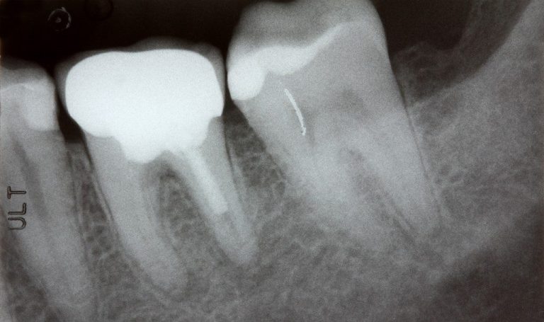 Oral Bacteria linked to Heart Rhythm Disorder