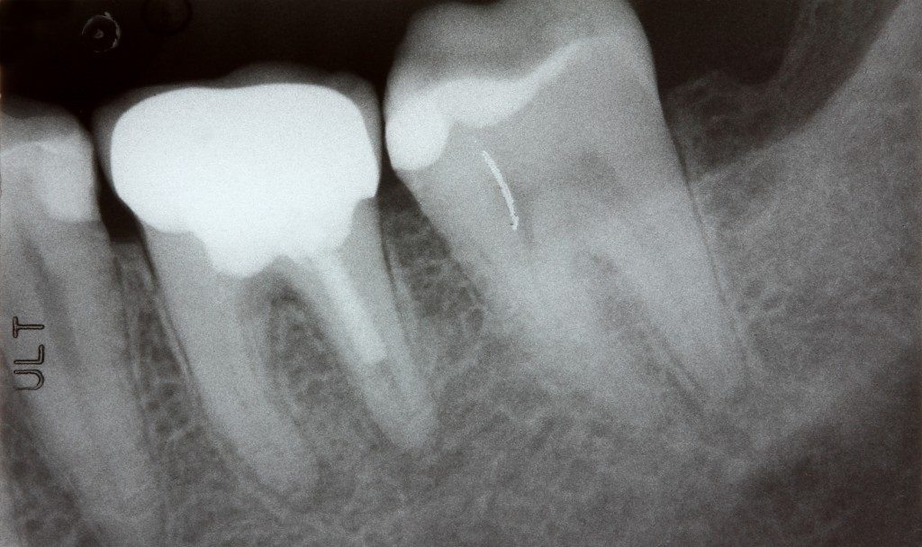 Oral Bacteria Linked To Heart Rhythm Disorder