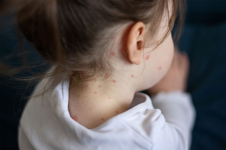 South Carolina battles accelerating measles outbreak, hundreds quarantined