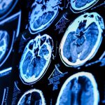 Clogged Brain Drains May Be An Early Warning Sign Of Alzheimer’s