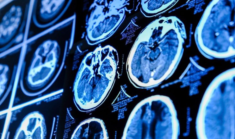 Clogged Brain Drains May Be An Early Warning Sign Of Alzheimer’s