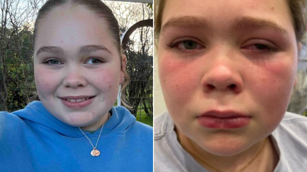 ‘Terrifying’: SA teen’s sight at risk after rare eye condition misdiagnosed