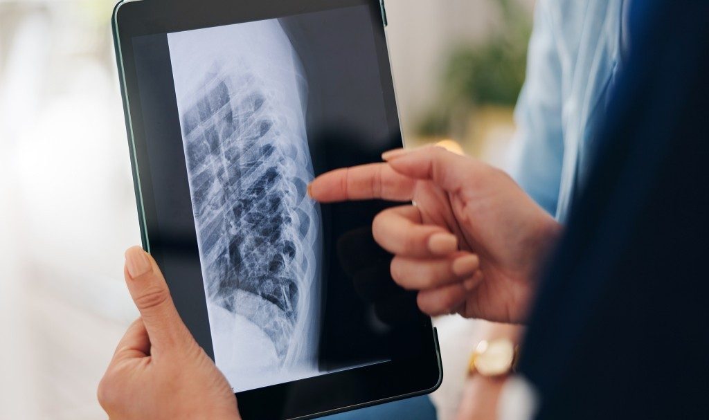 AI Can Help Spot Hidden Osteoporosis Risk From Chest X-Rays